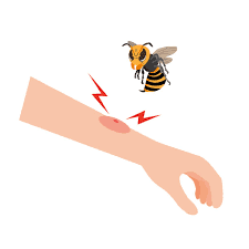 Insect bites/stings