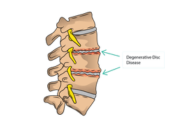 Degenerative Disc Disease