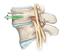 Spondylolisthesis