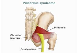 Piriformis Syndrome