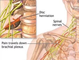 Compressed Nerves