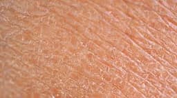 Dry Skin