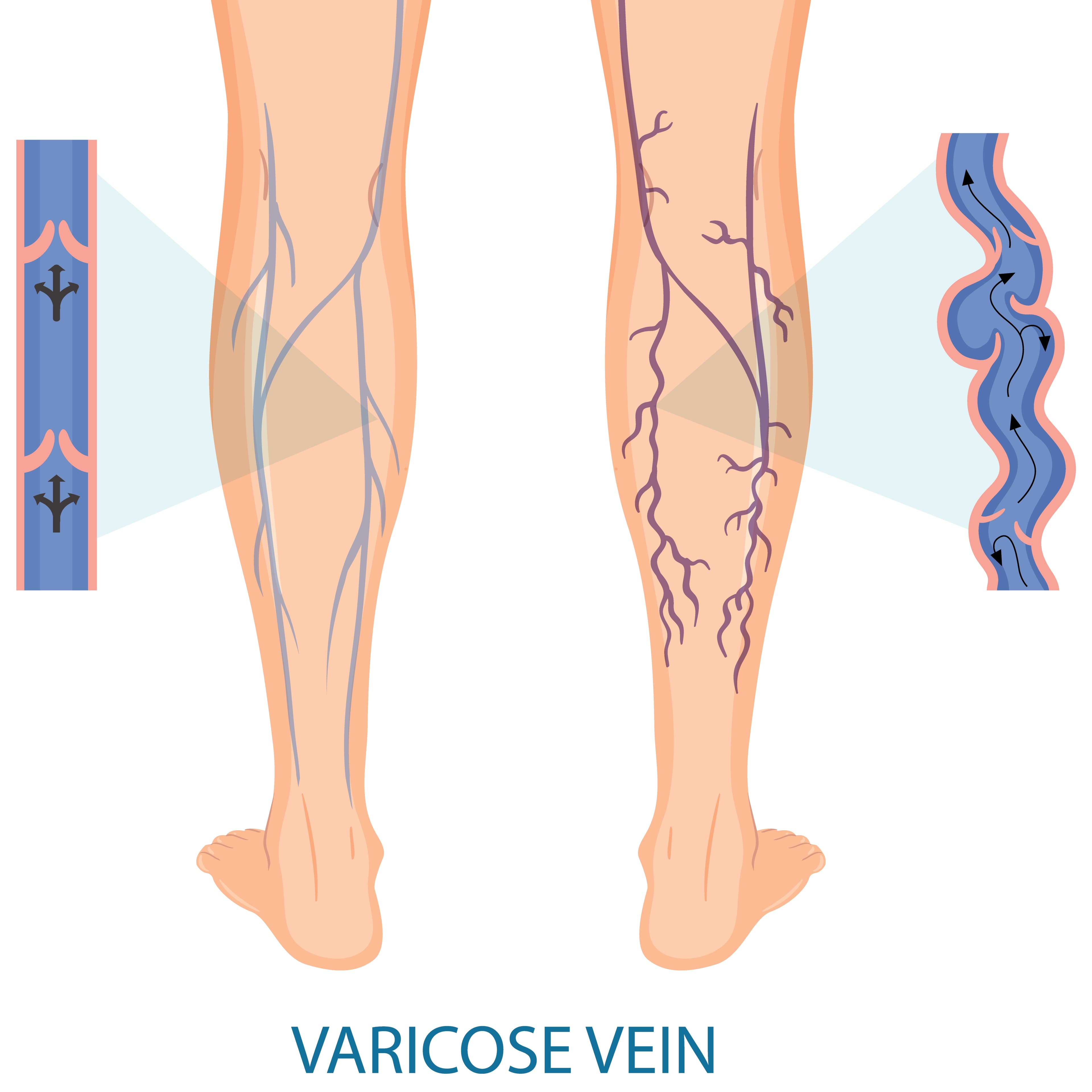 Varicose Veins (Deep vein thrombosis)