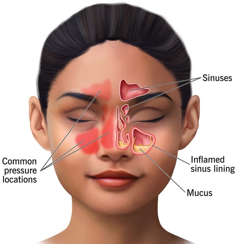 Nasal