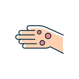 Rheumatoid Nodules