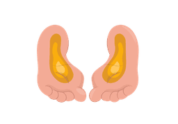 Plantar Fasciitis