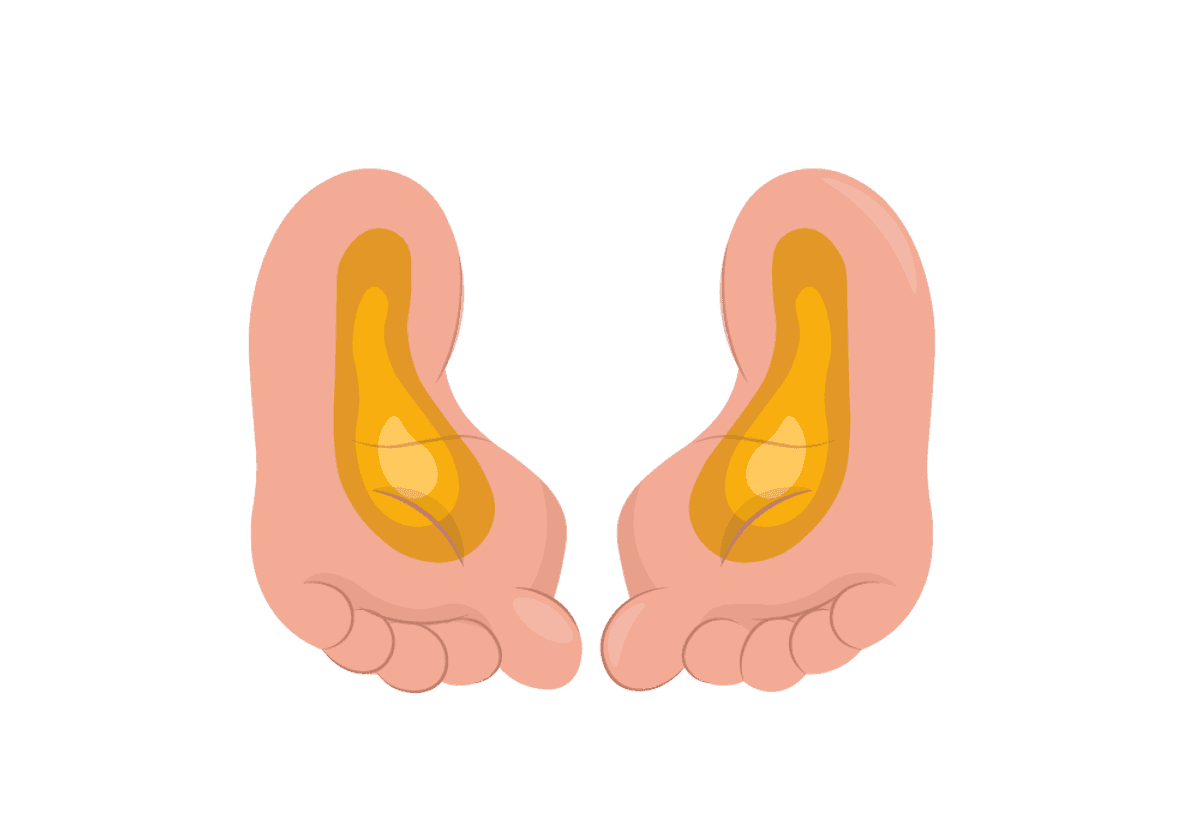Plantar Fasciitis