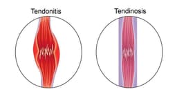 Tendinitis or Tendinosis