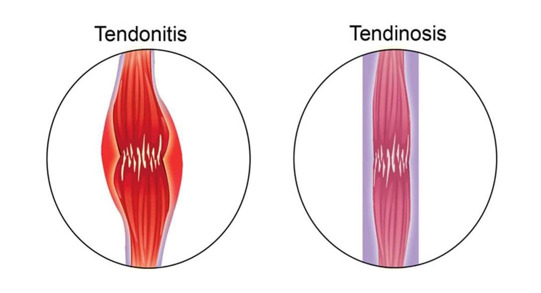 Tendinitis or Tendinosis