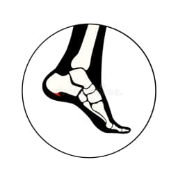 Heel Spurs