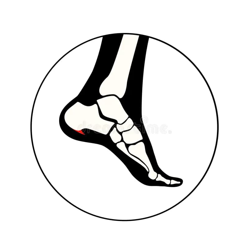 Heel Spurs