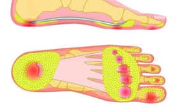 Fat Pad Atrophy
