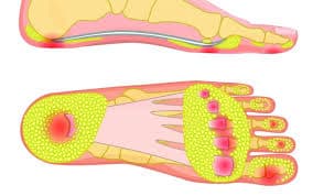 Fat Pad Atrophy