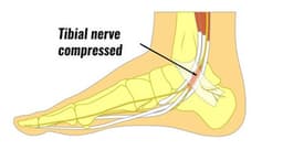 Tarsal Tunnel Syndrome