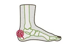 Sever's Disease