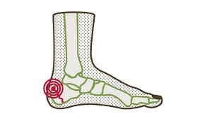 Sever's Disease