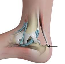 Haglund's Deformity