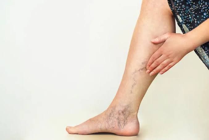 Is Varicose Veins Disturbing You?