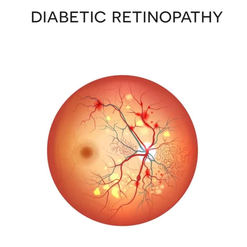 Diabetic Retinopathy
