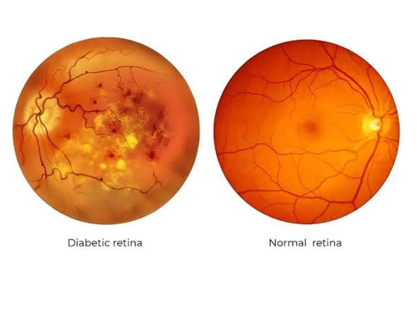 Diabetic Retinopathy & Homeopathy
