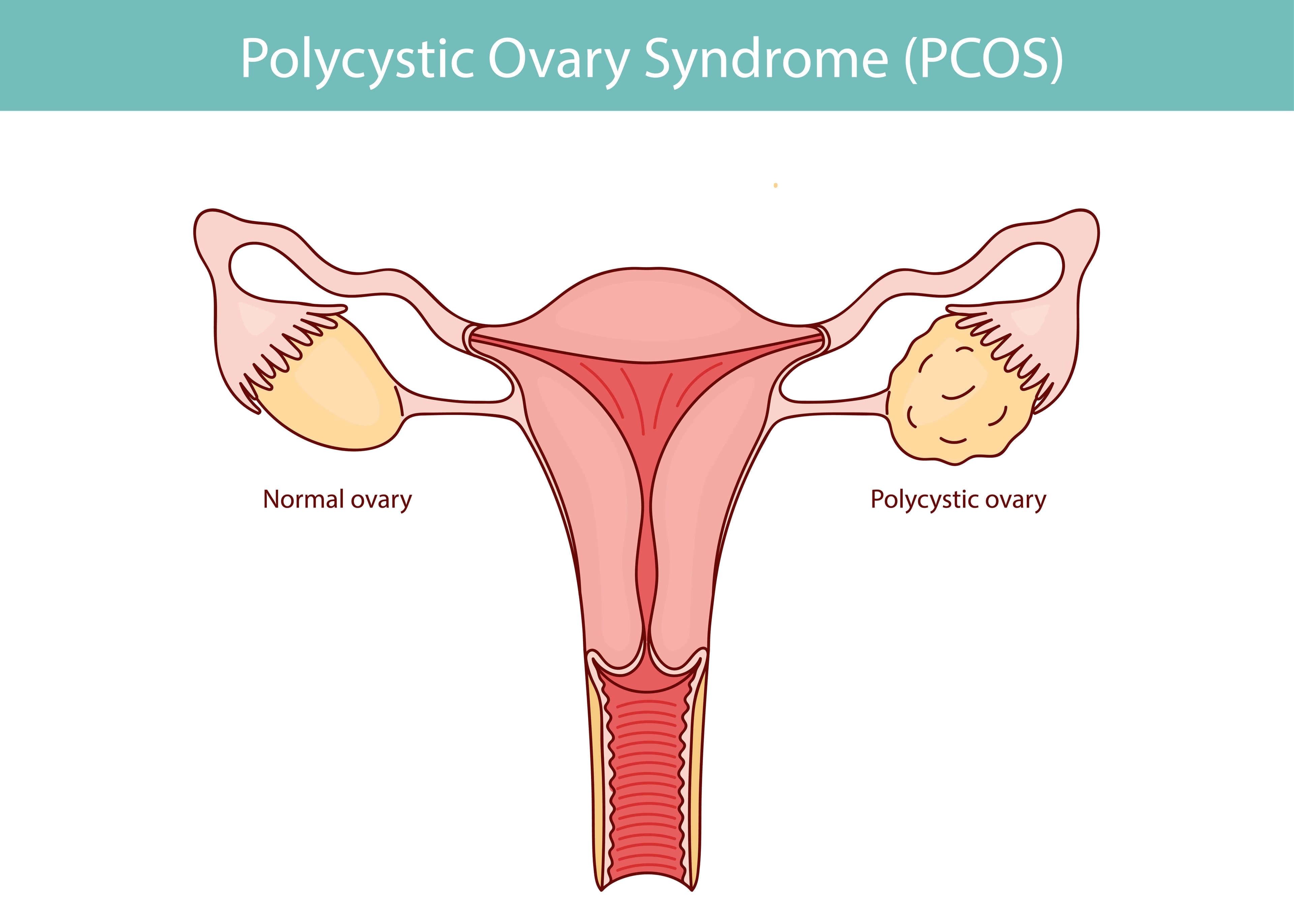 PCOS and Weight Gain: When to Seek Professional Help