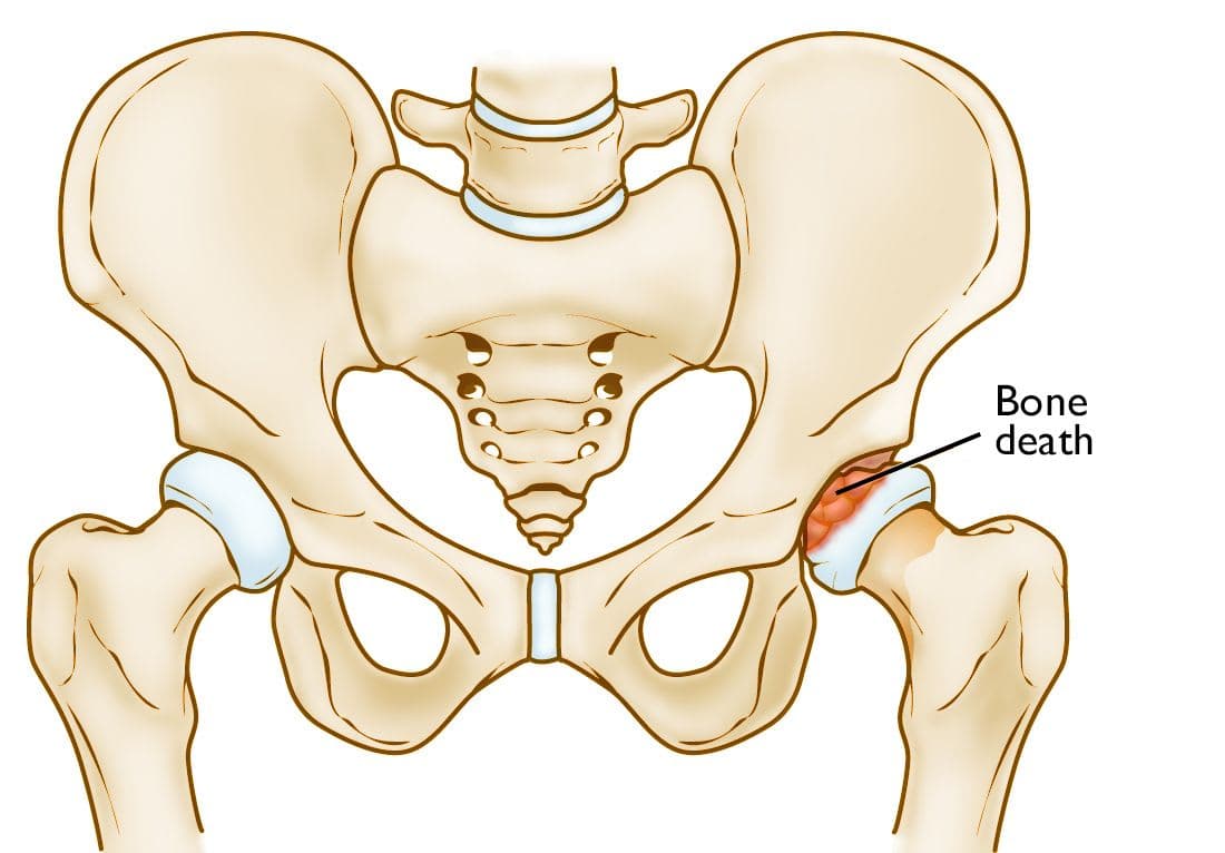 Perthes Disease in Children: A Case Report